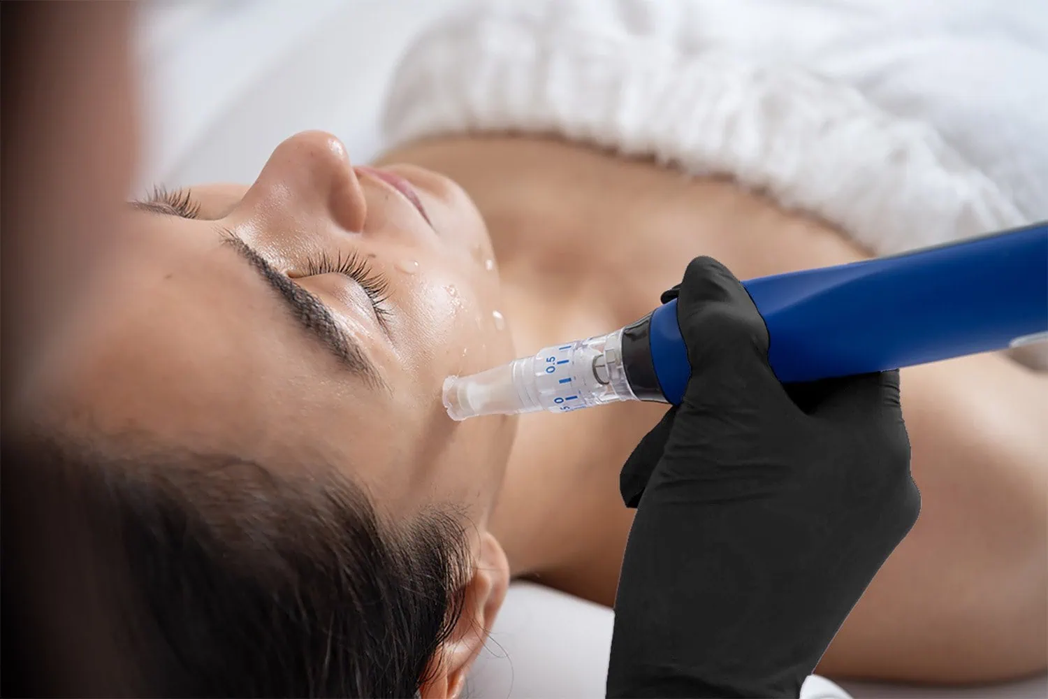Microneedling Treatment by Artmedica Aesthetics Vienna, VA