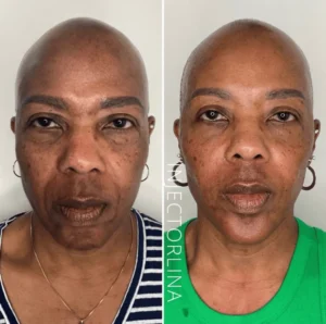 biostimulators Before and after by Artmedica Aesthetics