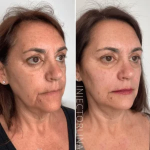 biostimulators Before and after by Artmedica Aesthetics