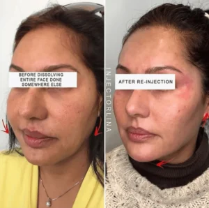 Before Dissolving and after Result by Artmedica Aesthetics