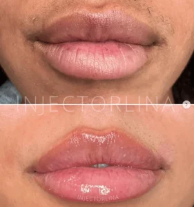 Lips Fillers treatment Before and after Result by Artmedica Aesthetics
