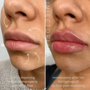 Lip fillers before and after results by Artmedica Aesthetics