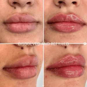 A Woman showing Lips Before and after Lips fillers by Artmedica Aesthetics