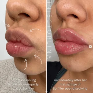 Lip fillers before and after results | Artmedica Aesthetics