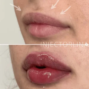 A Woman showing Lips Before and after Lips fillers Treatment by Artmedica Aesthetics