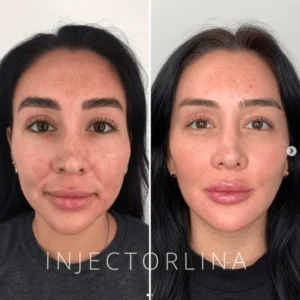 A woman with dark hair by Artmedica Aesthetics