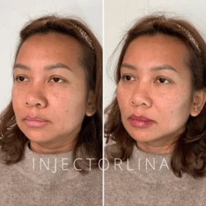 Woman before and after lip filler and chin contouring treatment