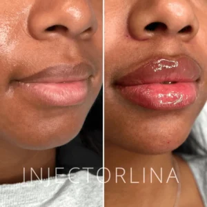 Woman before and after lip filler treatment by Artmedica Aesthetics
