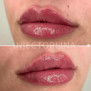 Lip fillers Before and after lips Treatment Result by Artmedica Aesthetics