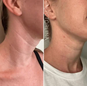 A collage of a woman's neck and Chin Before and after treatment