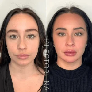 Dermal Fillers before and after Treatment by Artmedica Aesthetics