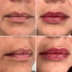 Lips Fillers treatment Before and after Result by Artmedica Aesthetics