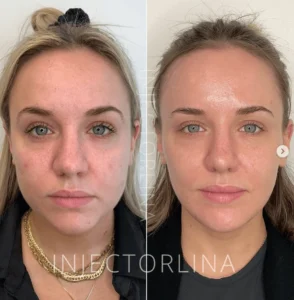 Lips Fillers treatment Before and after Result by Artmedica Aesthetics