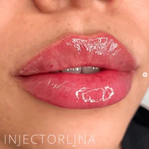 Lip Fillers Treatment by Artmedica Aesthetics