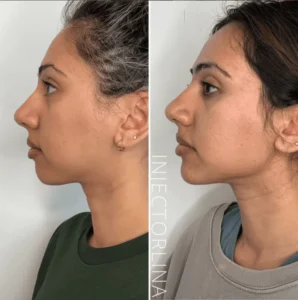 Lina Colleli Botox | Filler Treatment by Artmedica Aesthetics