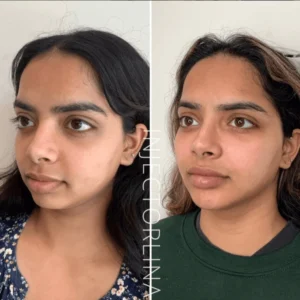 Dermal Fillers treatment by Artmedica Aesthetics