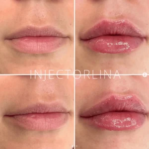 Lips fillers before and after result