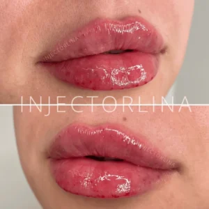 Lip fillers Treatment by Artmedica Aesthetics