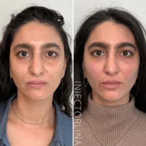 Botox Treatment before and after Results
