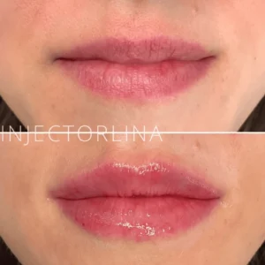 Lips Fillers treatment before and after Result by Artmedica Aesthetics