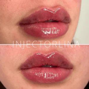 Lips Fillers before and after Result with Artmedica Aesthetics