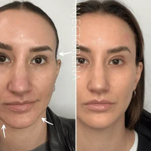 Woman before and after jawline and chin filler treatment