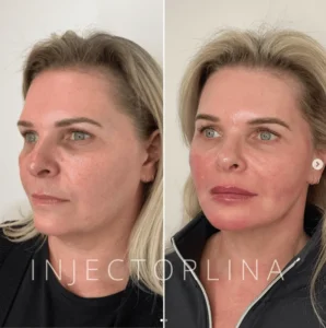 Woman before and after full-face rejuvenation with dermal fillers