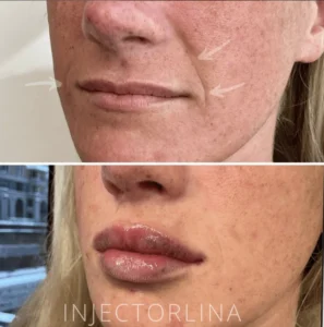 Lips and smile lines before and after dermal filler treatment