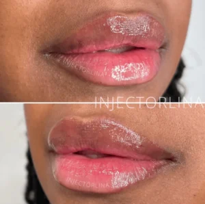 Lip fillers before and after Result | Artmedica Aesthetics