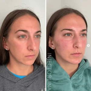 Woman before and after facial balancing treatment with dermal fillers