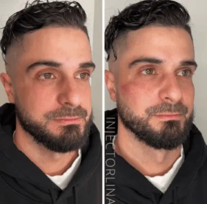 dermal fillers Before and after Resullt by Artmedica Aesthetics