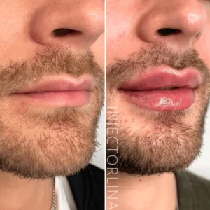 dermal fillers Before and after Resullt by Artmedica Aesthetics