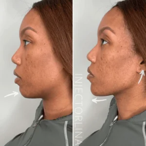 dermal fillers Before and after Resullt by Artmedica Aesthetics