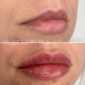 Lips before and after lip filler enhancement treatment