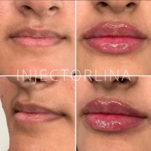 Lips before and after lip filler treatment by Artmedica Aesthetics