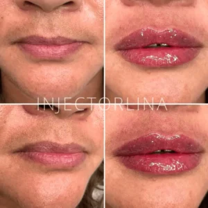 Lips before and after lip filler treatment by Artmedica Aesthetics