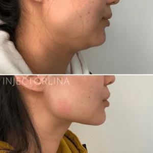woman's face fat dissolving before and after | Artmedica Aesthetics
