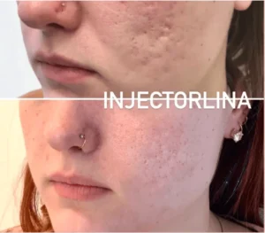 Woman's face before and after microneedling treatment at Artmedica Aesthetics