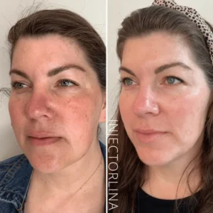 Before and after microneedling treatment at Artmedica Aesthetics