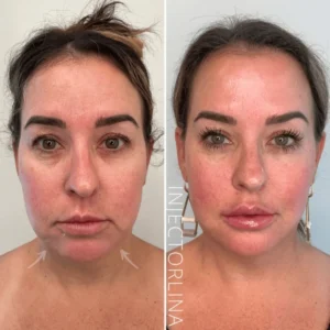 Woman before and after chin and jawline filler treatment