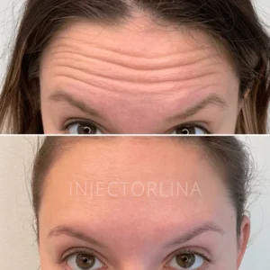 neuromodulator before and after | Artmedica Aesthetics Vienna, VA