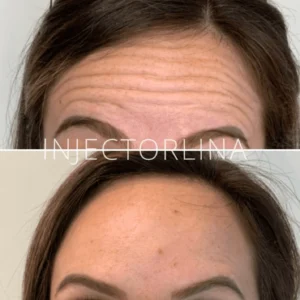 Forehead before and after Botox treatment for wrinkle reduction
