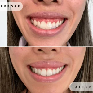 Neuromodulator Treatment Before and After Result by Artmedica Aesthetics Vienna, VA