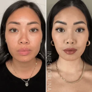 Woman before and after dermal filler treatment