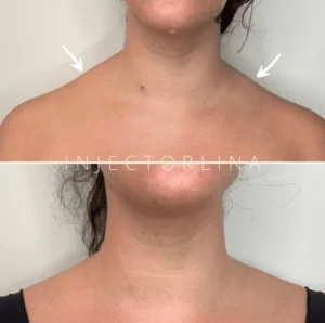 A woman with a mole on her neck, before and after, Glowing skin