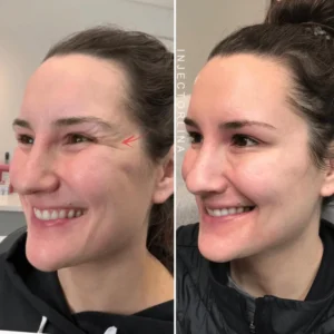 Neuromodulator Before and After Result by Artmedica Aesthetics