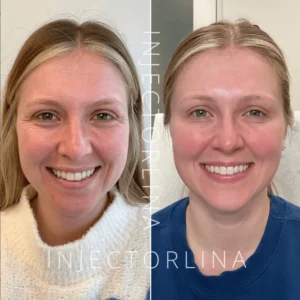 Before and after Botox treatment | Artmedica Aesthetics