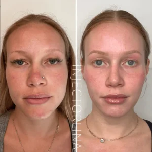 Forehead before and after Botox treatment for wrinkle reduction | Artmedica Aesthetics