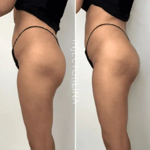 Nonsurgical Bbl Before and After | Artmedica Aesthetics