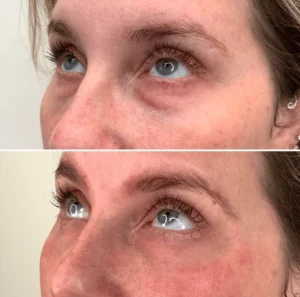 A woman's face PRF before and after | Artmedica Aesthetics